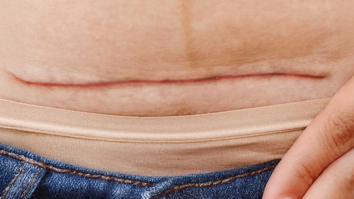 3 cosas sobre la cesárea que todo hombre debe saber