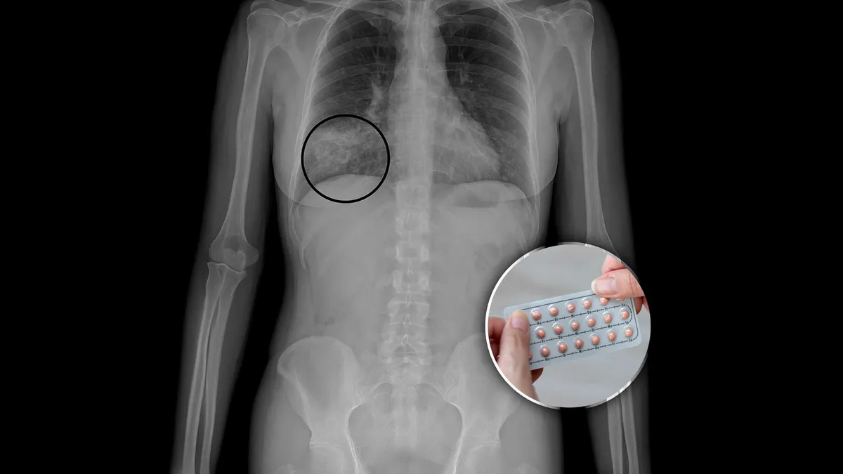 3 datos de la píldora anticonceptiva que debes saber ¿Da cáncer?