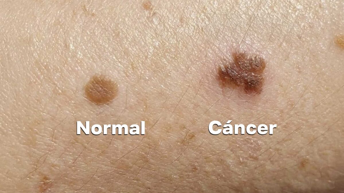3 DIFERENCIAS ENTRE UN LUNAR NORMAL Y UNO QUE PODRÍA SER CÁNCER