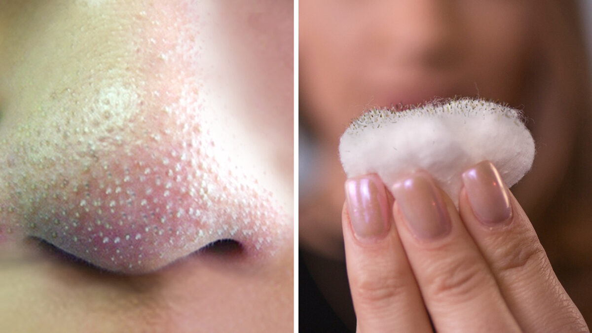 ¿Cómo quitar puntos negros y espinillas de forma natural?