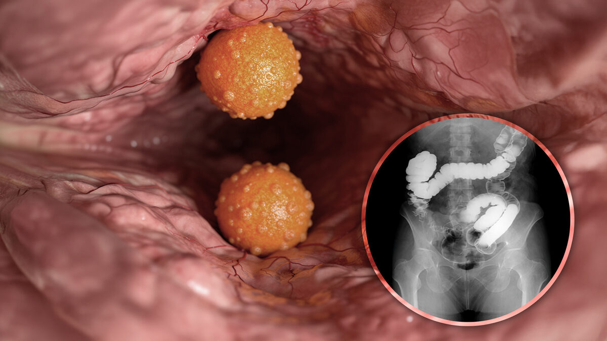 Oncólogo revela 5 comidas que aumentan el riesgo de cáncer