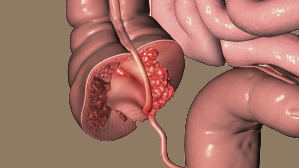 ¿Qué es la apendicitis y por qué es tan peligrosa?
