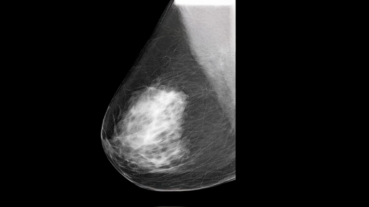 Síntomas de cáncer de mama que todas las mujeres deben conocer