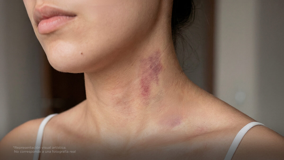 Sufrió un derrame cerebral por un chupetón en el cuello