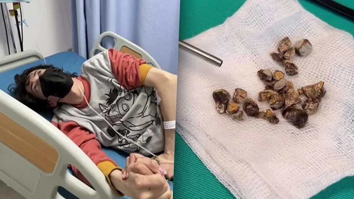 URGENTE | Le encontraron 35 piedras en el riñón por tomar refresco